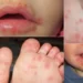 Deja virus ‘boca-mano-pie’ sin clases a 43 alumnos