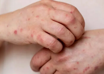 Tamaulipas se mantiene sin casos de sarampión y con dengue bajo control