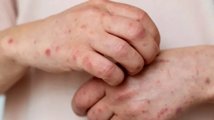 Tamaulipas se mantiene sin casos de sarampión y con dengue bajo control