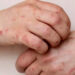 Tamaulipas se mantiene sin casos de sarampión y con dengue bajo control